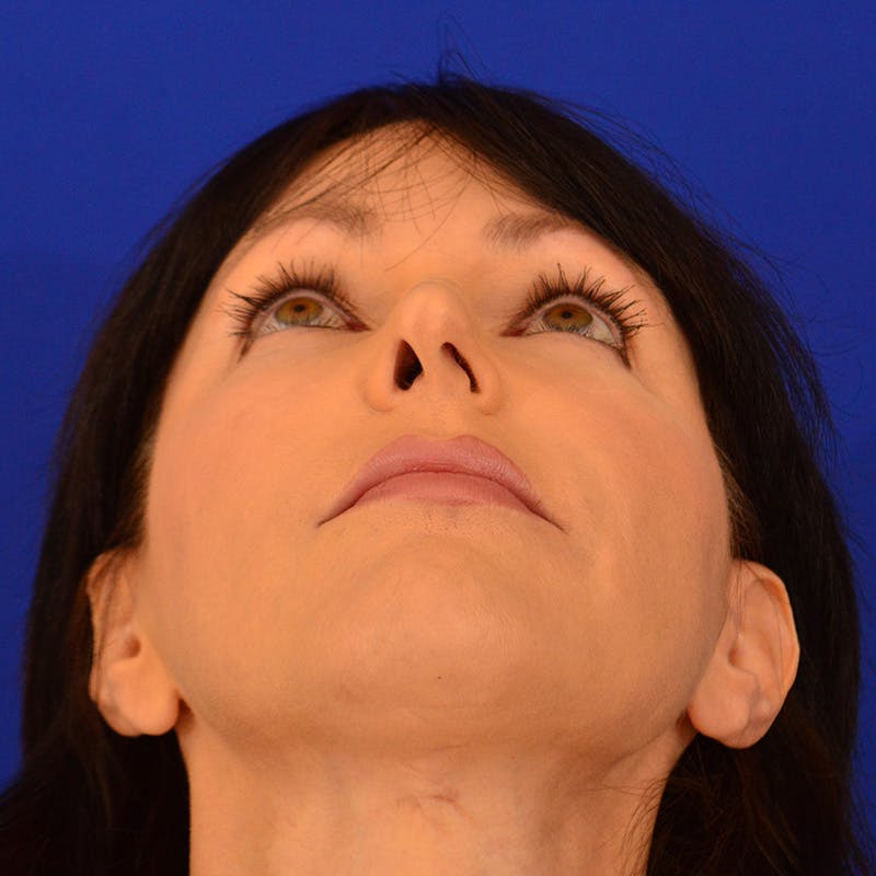 Crooked Nose Before & After Gallery - Patient 158738 - Image 11