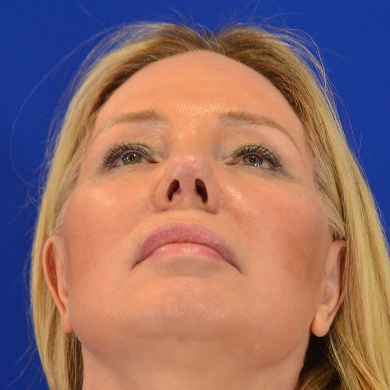 Revision Rhinoplasty Before & After Gallery - Patient 156468 - Image 12