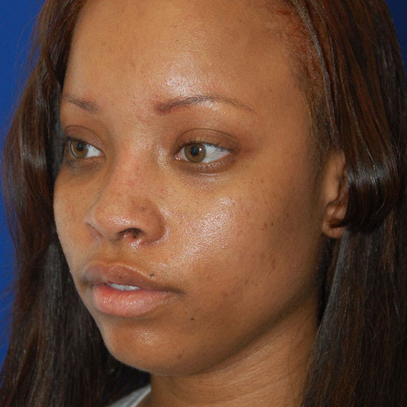 Wide Nose Before & After Gallery - Patient 155718 - Image 4