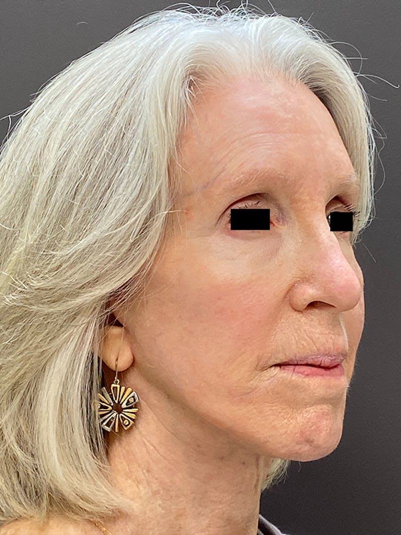 Brow Lift Before & After Gallery - Patient 306392 - Image 4