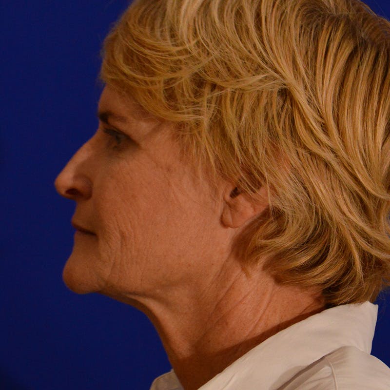 Co2 Laser Resurfacing Before & After Gallery - Patient 380986 - Image 9