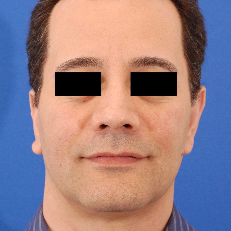 Male Rhinoplasty Before & After Gallery - Patient 785244 - Image 4
