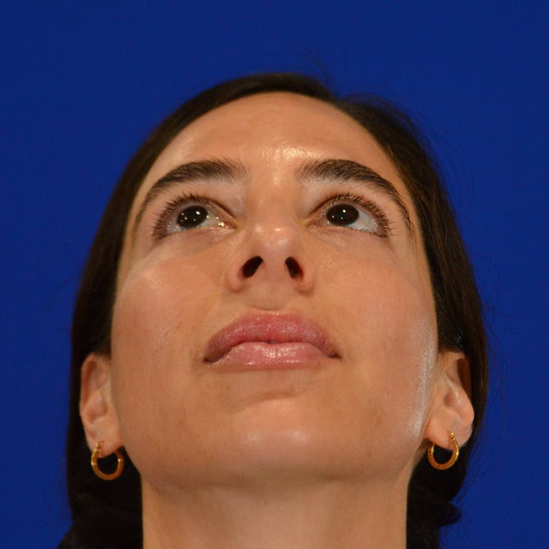 Facial Fat Grafting Before & After Gallery - Patient 411676 - Image 12