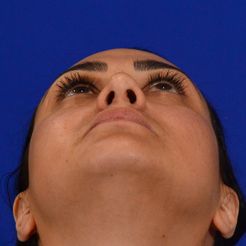 Ethnic Rhinoplasty Before & After Gallery - Patient 116783 - Image 14
