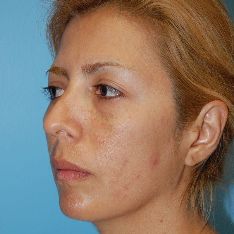 Crooked Nose Before & After Gallery - Patient 303792 - Image 3