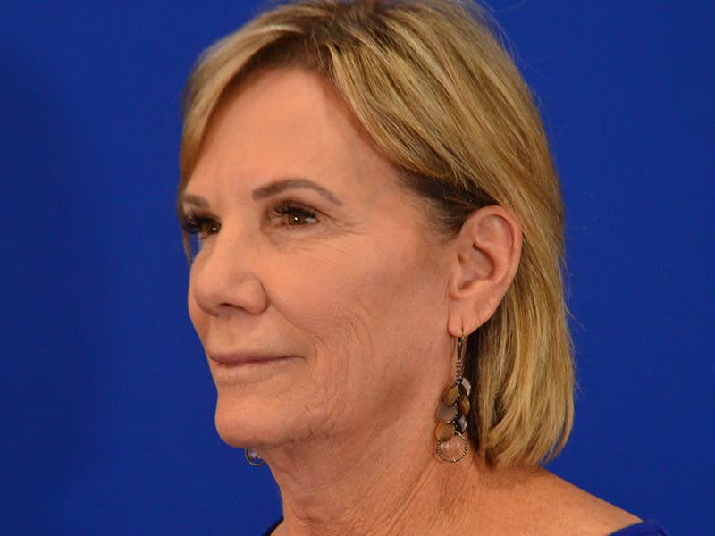 Facelift & Necklift Before & After Gallery - Patient 536616 - Image 5