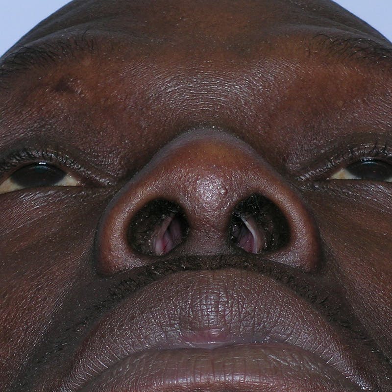 Wide Nose Before & After Gallery - Patient 129259 - Image 12