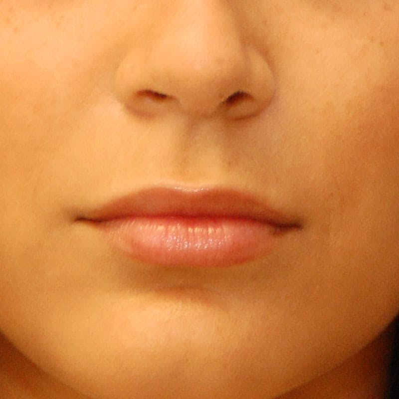 Lip Filler Before & After Gallery - Patient 289604 - Image 2