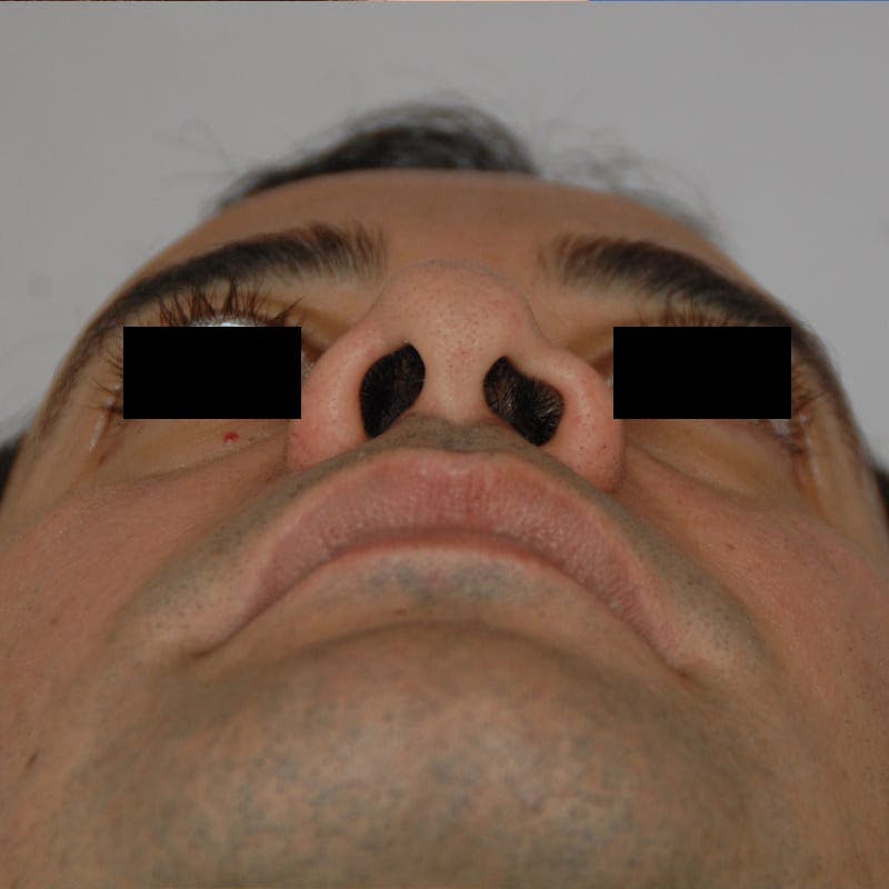 Male Rhinoplasty Before & After Gallery - Patient 785244 - Image 7