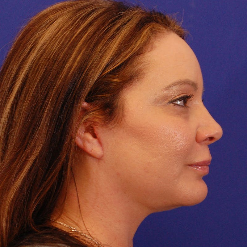 Facelift & Necklift Before & After Gallery - Patient 922406 - Image 6