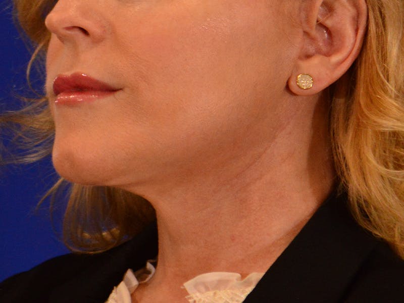 Facelift & Necklift Before & After Gallery - Patient 654569 - Image 8