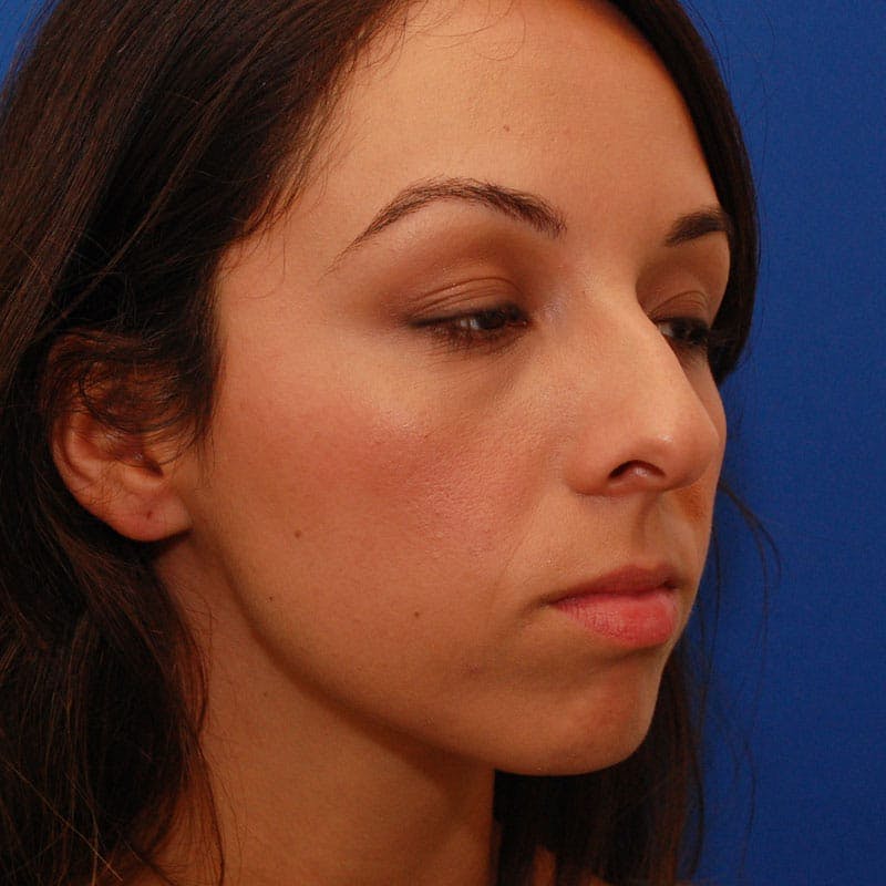Wide Nose Before & After Gallery - Patient 308012 - Image 3