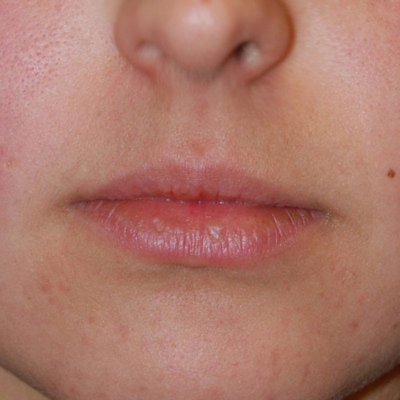 Lip Filler Before & After Gallery - Patient 722899 - Image 1