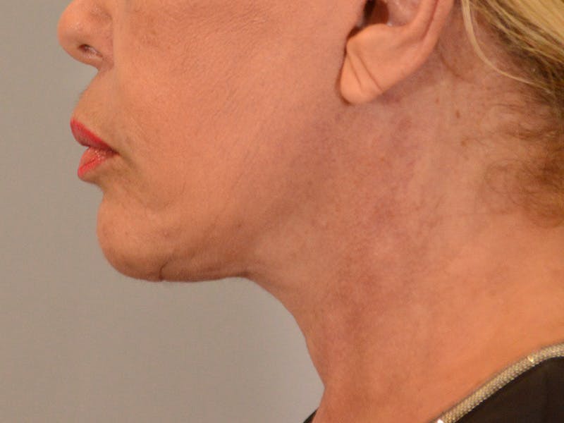 Facelift & Necklift Before & After Gallery - Patient 299407 - Image 2