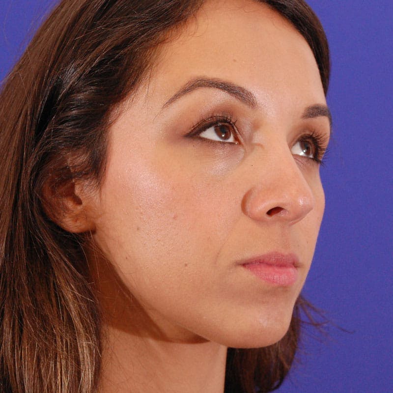 Wide Nose Before & After Gallery - Patient 308012 - Image 4