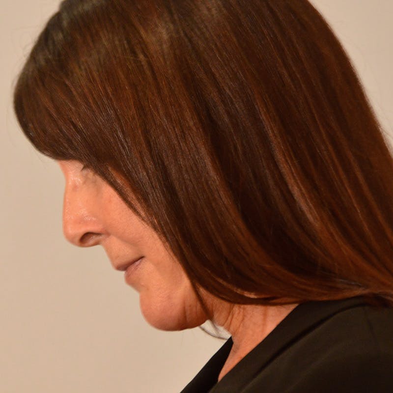 Facelift & Necklift Before & After Gallery - Patient 246000 - Image 14