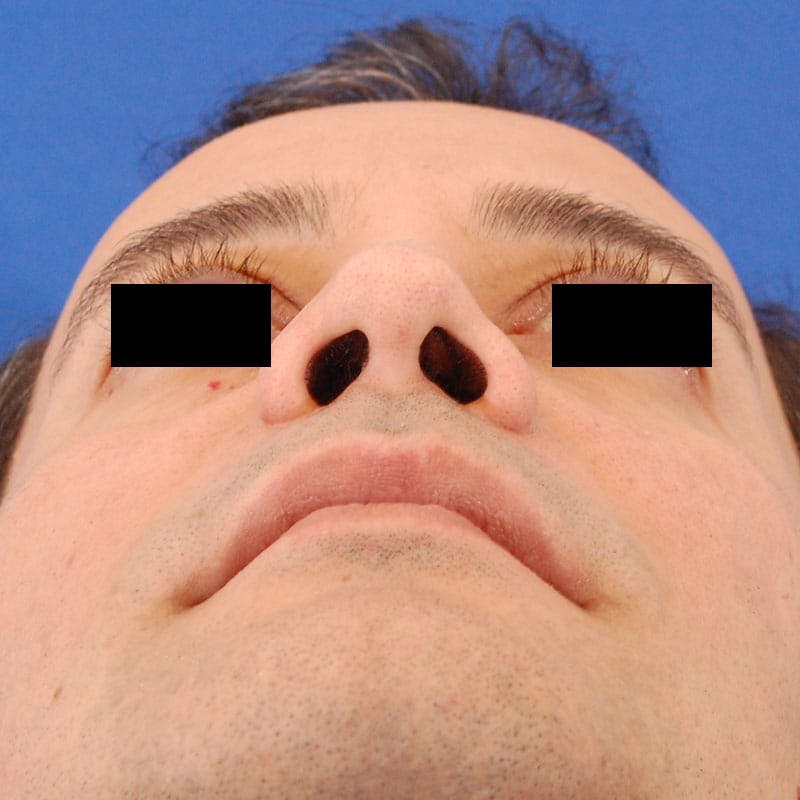 Male Rhinoplasty Before & After Gallery - Patient 785244 - Image 8