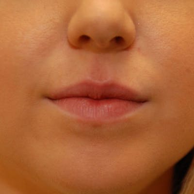 Lip Filler Before & After Gallery - Patient 255888 - Image 2