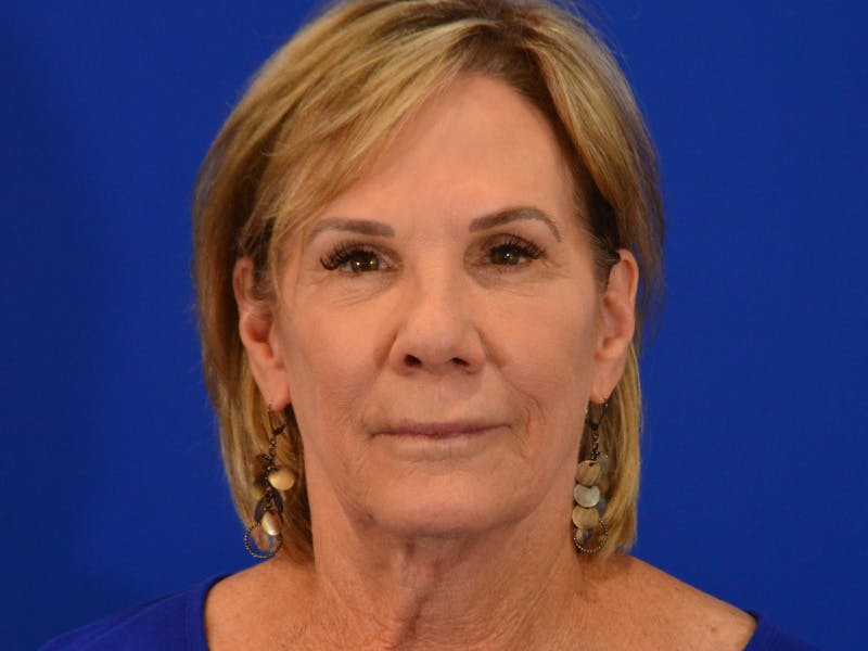 Facelift & Necklift Before & After Gallery - Patient 536616 - Image 1