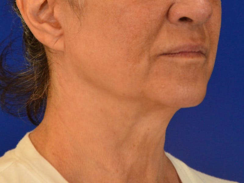 Facelift & Necklift Before & After Gallery - Patient 162323 - Image 4