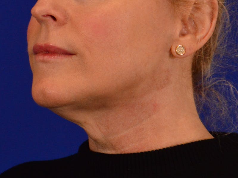 Facelift & Necklift Before & After Gallery - Patient 654569 - Image 7