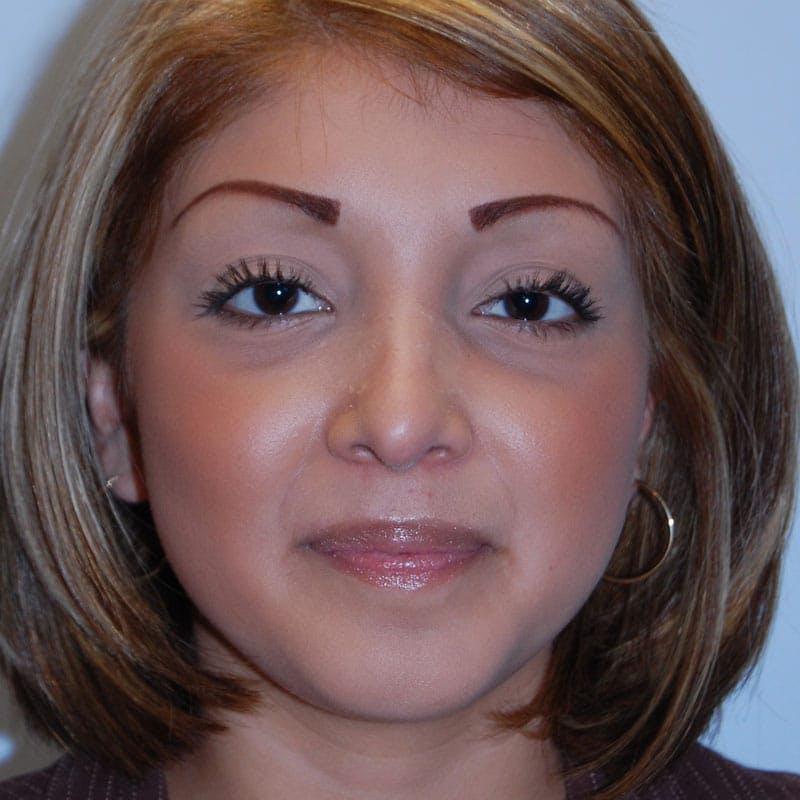 Long Nose Before & After Gallery - Patient 404621 - Image 2