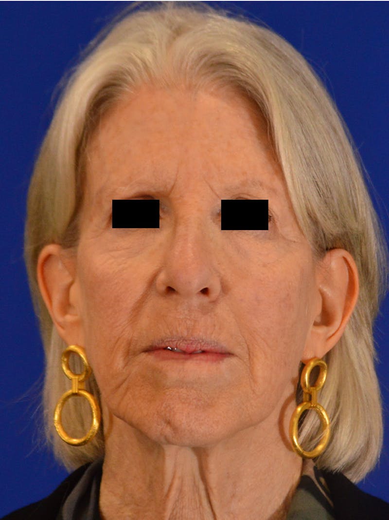 Brow Lift Before & After Gallery - Patient 306392 - Image 1