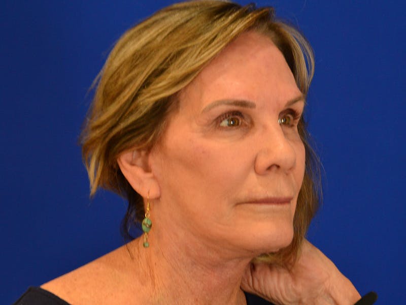Facelift & Necklift Before & After Gallery - Patient 536616 - Image 4