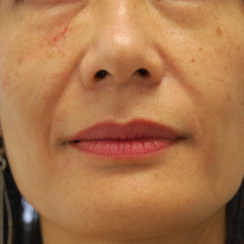 Lip Filler Before & After Gallery - Patient 219472 - Image 1