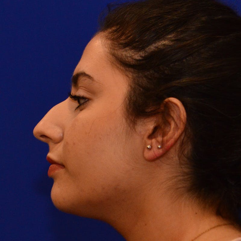 Dorsal Hump Before & After Gallery - Patient 275379 - Image 1