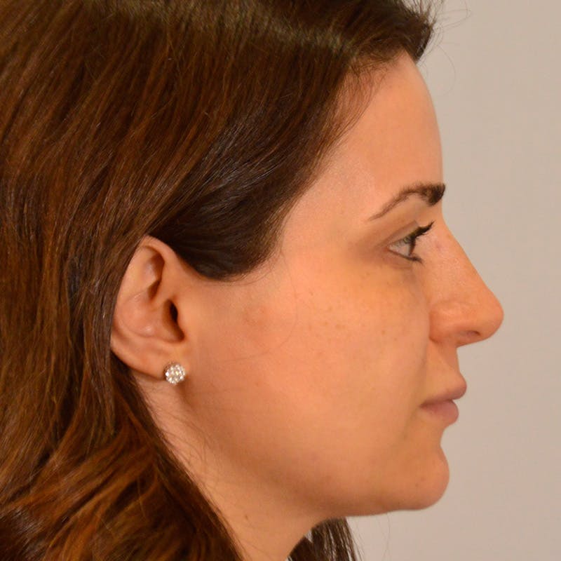 Dorsal Hump Before & After Gallery - Patient 911758 - Image 8
