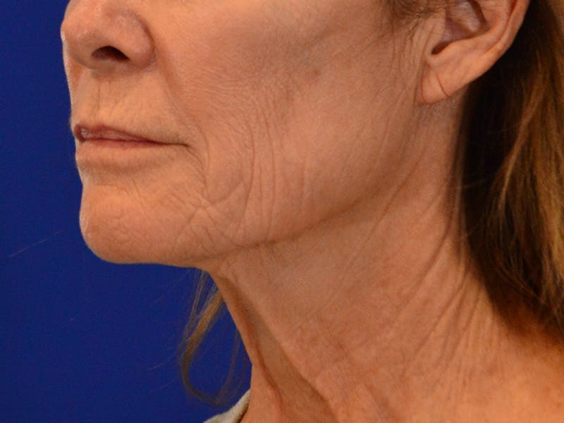Facelift & Necklift Before & After Gallery - Patient 181377 - Image 7
