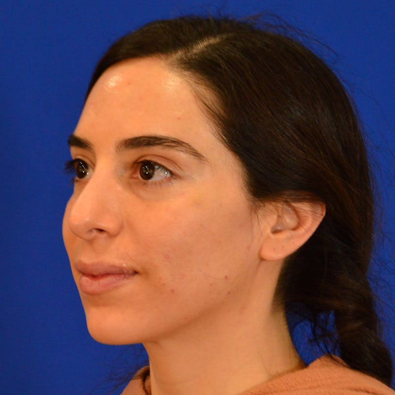 Facial Fat Grafting Before & After Gallery - Patient 411676 - Image 7