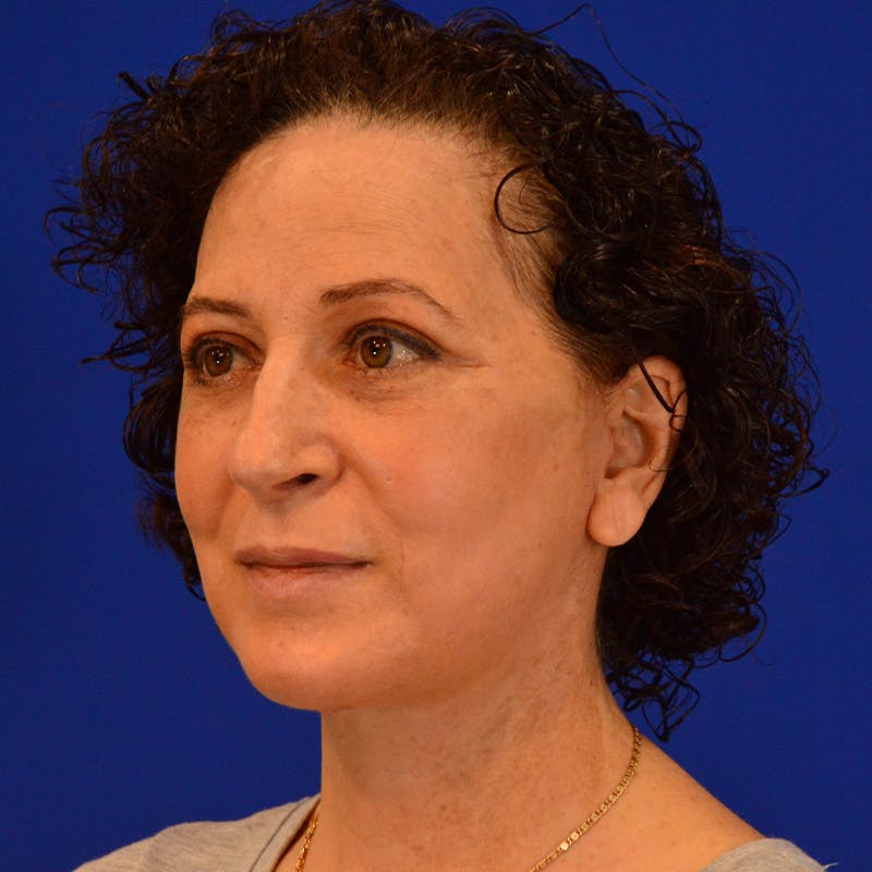 Facelift & Necklift Before & After Gallery - Patient 217555 - Image 8