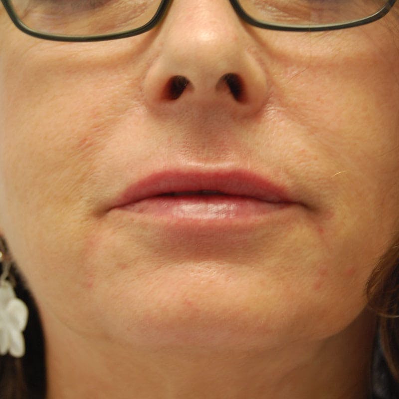 Lip Filler Before & After Gallery - Patient 299364 - Image 2