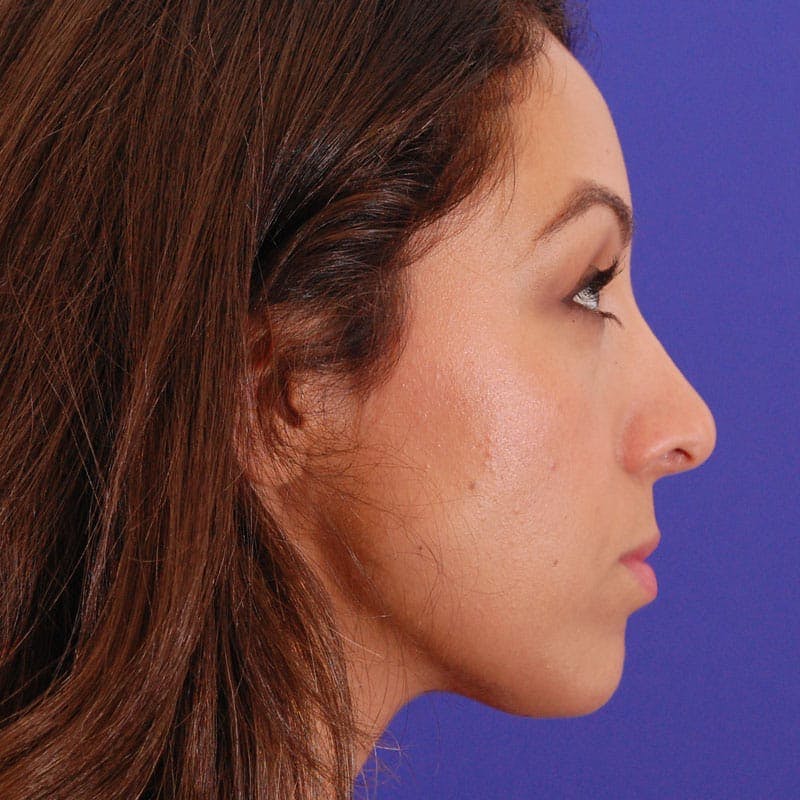 Wide Nose Before & After Gallery - Patient 308012 - Image 6