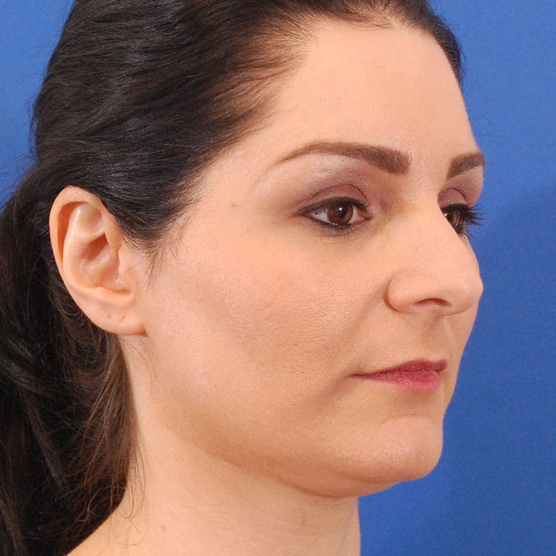 Long Nose Before & After Gallery - Patient 529509 - Image 3