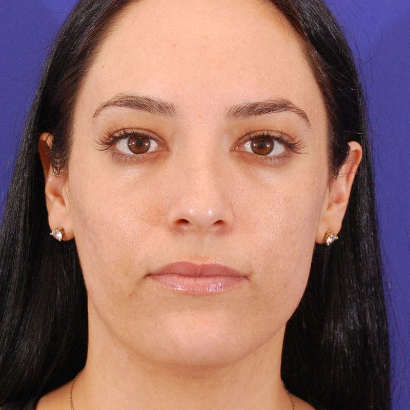 Dorsal Hump Before & After Gallery - Patient 319034 - Image 4
