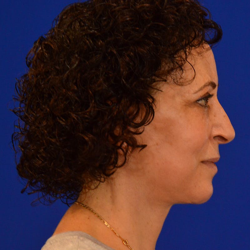 Facelift & Necklift Before & After Gallery - Patient 217555 - Image 6