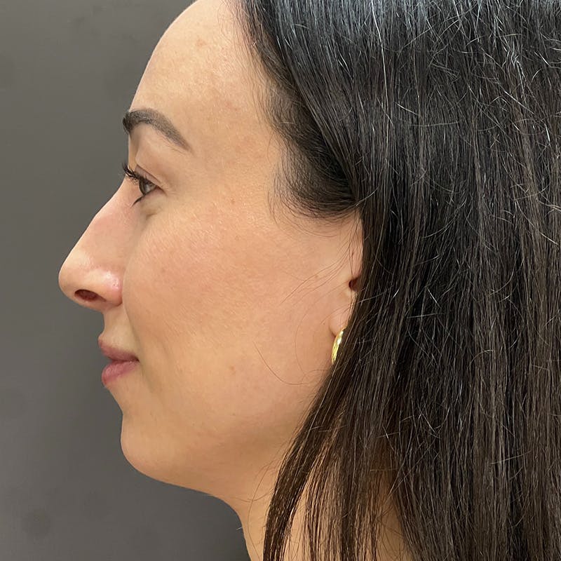 Small Changes Before & After Gallery - Patient 213801 - Image 3