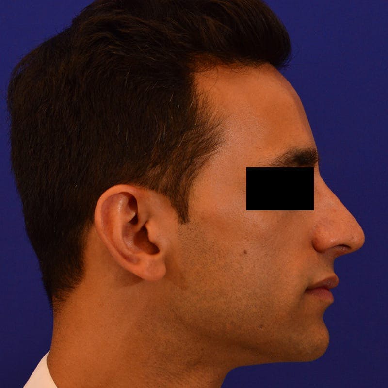 Male Rhinoplasty Before & After Gallery - Patient 249871 - Image 2