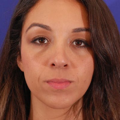 Long Nose Before & After Gallery - Patient 248995 - Image 2