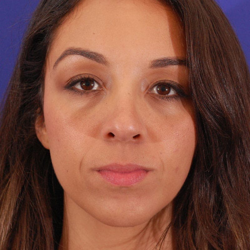 Wide Nose Before & After Gallery - Patient 308012 - Image 2