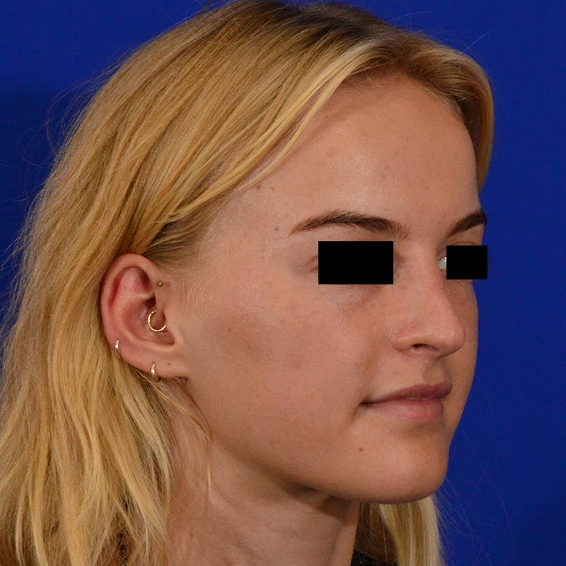Female Rhinoplasty Before & After Gallery - Patient 124593 - Image 6