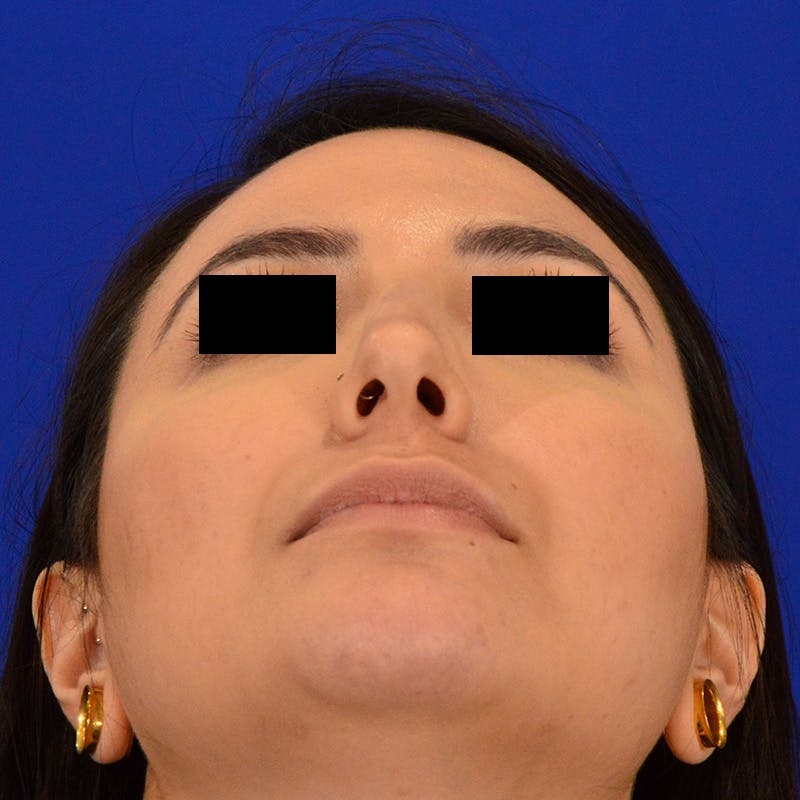 Dorsal Hump Before & After Gallery - Patient 750880 - Image 11