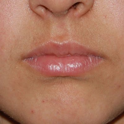 Lip Filler Before & After Gallery - Patient 722899 - Image 2
