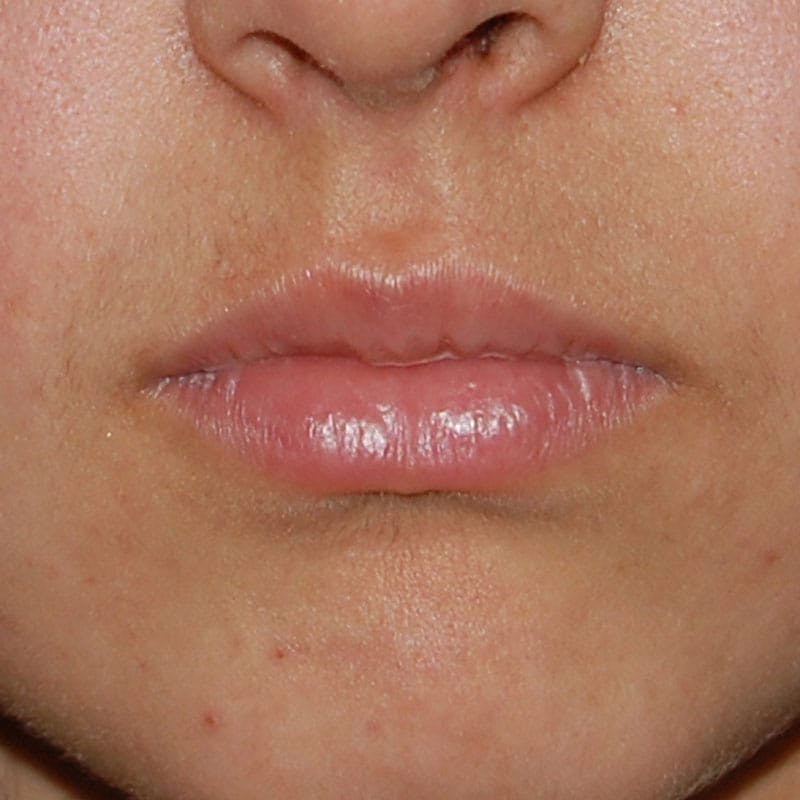 Lip Filler Before & After Gallery - Patient 722899 - Image 2
