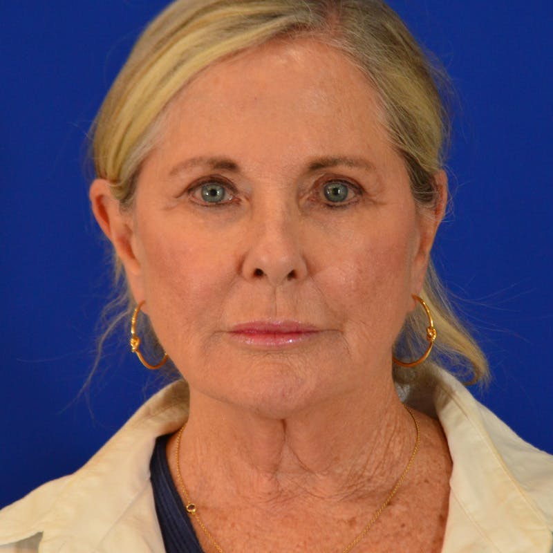 Co2 Laser Resurfacing Before & After Gallery - Patient 940417 - Image 1