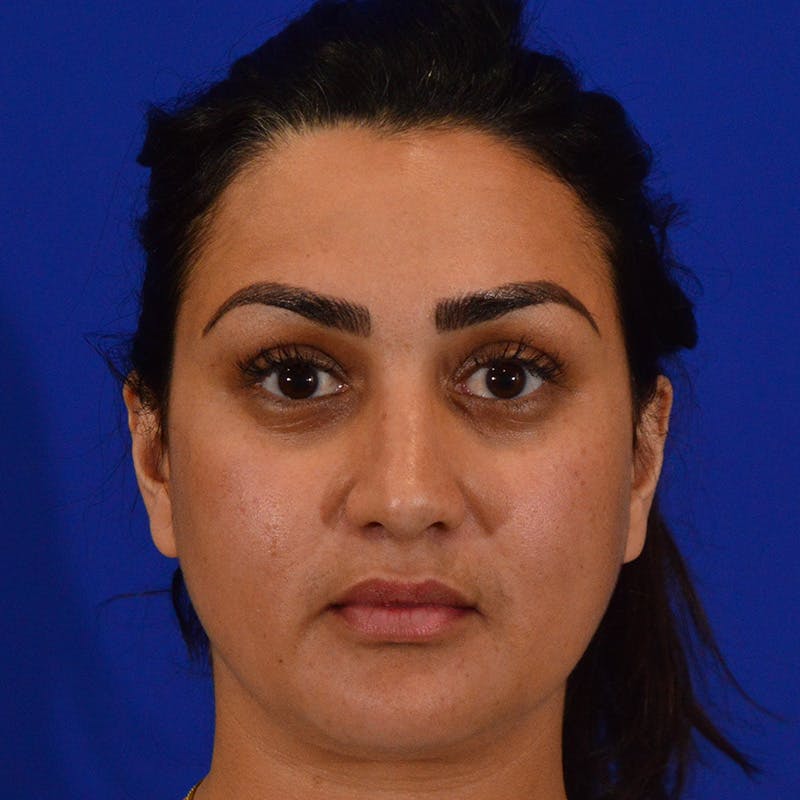 Ethnic Rhinoplasty Before & After Gallery - Patient 116783 - Image 6