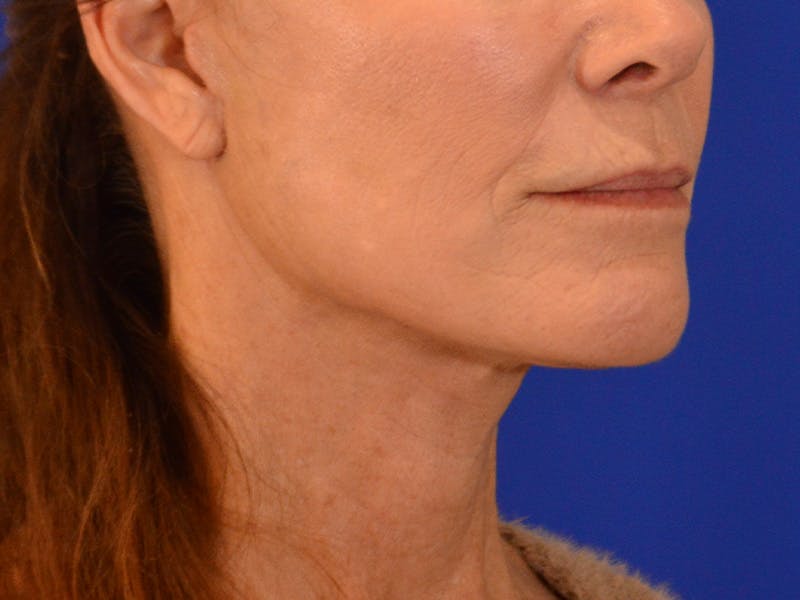Facelift & Necklift Before & After Gallery - Patient 181377 - Image 4